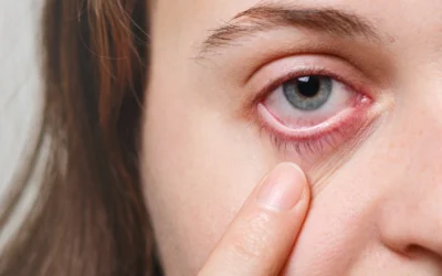 ¿Cómo tratar la blefaritis y mantener una higiene palpebral correcta?