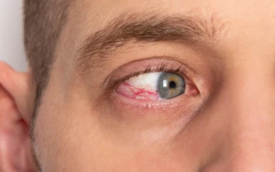 ¿Qué es la conjuntivitis y cómo la identifico y trato?